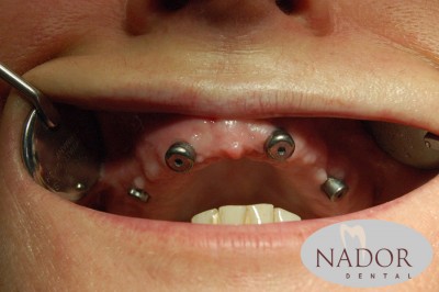 Implantátum beültetése biszfoszfonát tartalmú gyógyszerek szedése esetén  